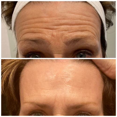 Botox (forehand and frown lines)