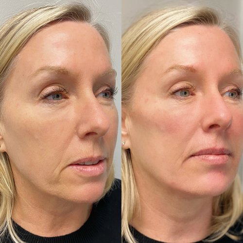 Contour Lift with Filler Sprinkle-2
