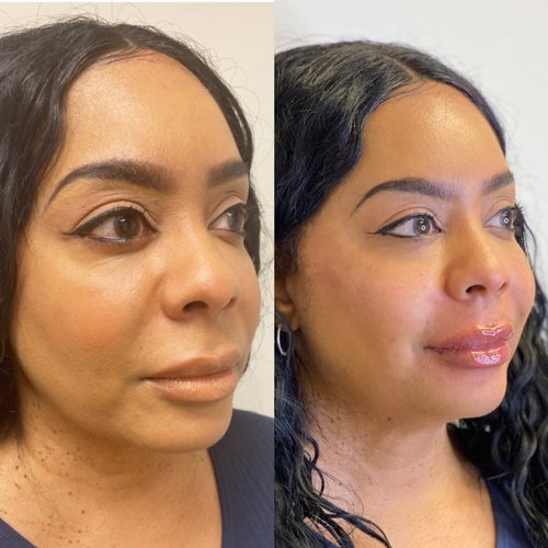Contour Lift with Filler Sprinkle-3