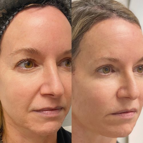 Contour Lift with Filler Sprinkle