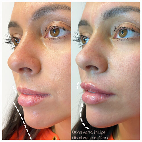Profile Balancing with Chin Filler and Lip Filler