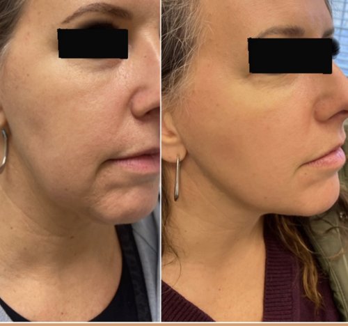 Profile Balancing with Jawline Contour Filler, Threads
