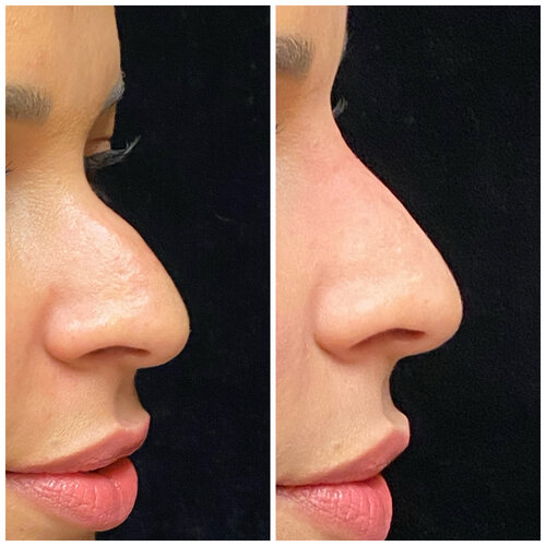 Profile Balancing with Nose Filler-1