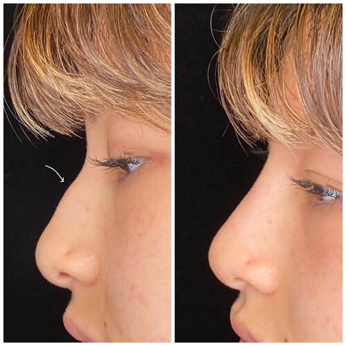 Profile Balancing with Nose Filler-2