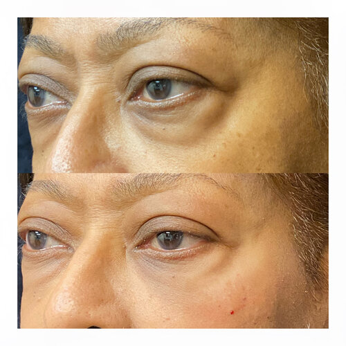 Signature Eye Refresh (with Cannula)