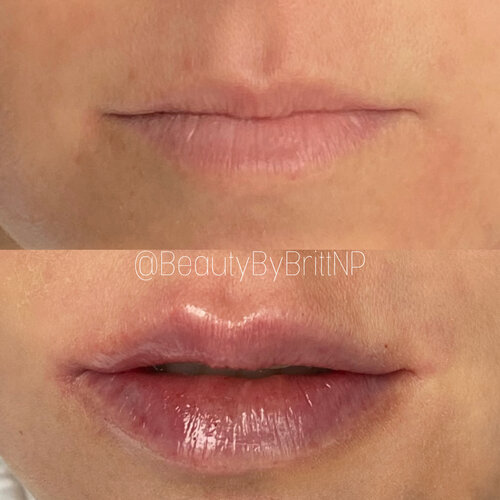 Signature Natural Hydration with Lip Filler-2