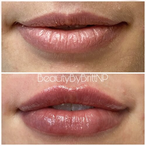Signature Natural Hydration with Lip Filler-3