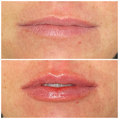 Signature Natural Hydration with Lip Filler