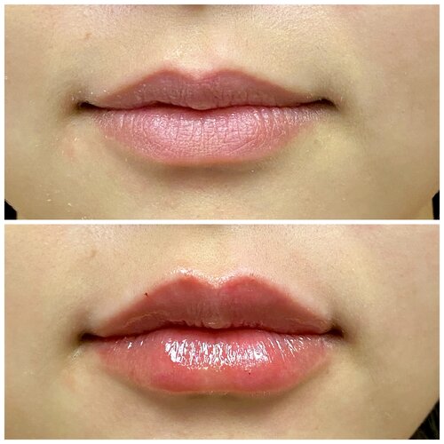 Signature Perfect Pout with Lip Filler
