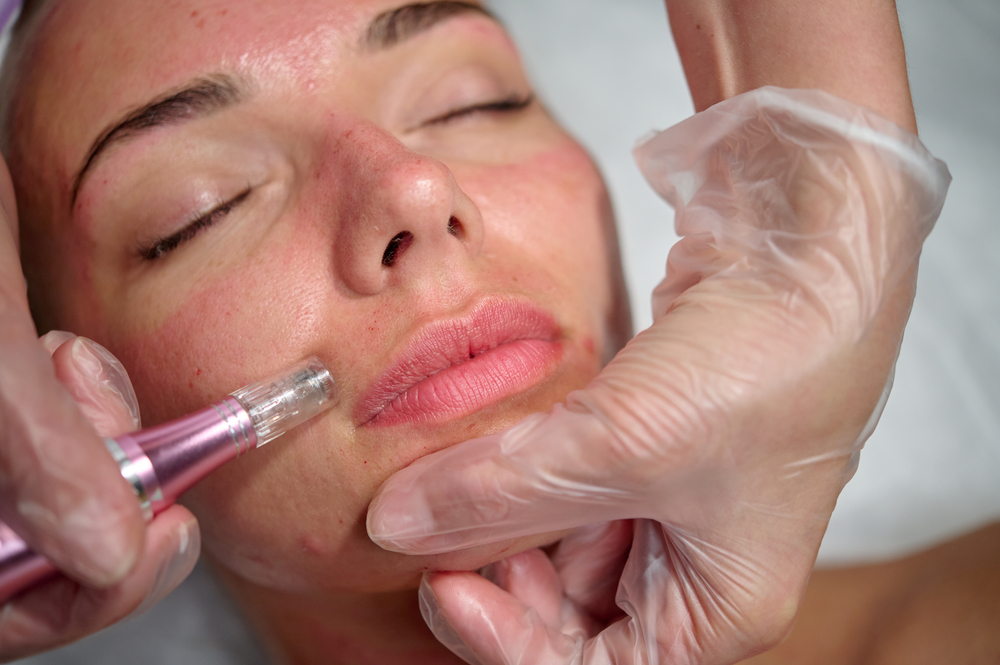 Microneedling Columbia